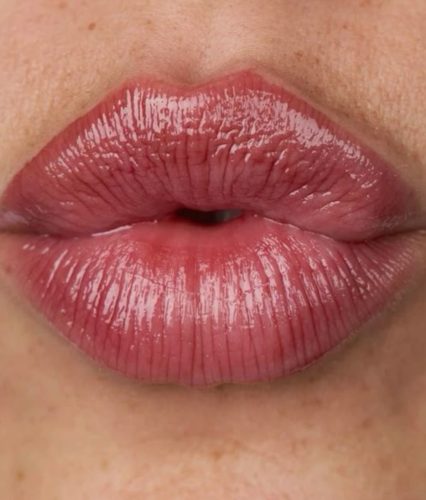 Full Lips Botox photo review