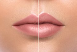 Full Lips Botox® Lip Plumper Treatment - Image 6