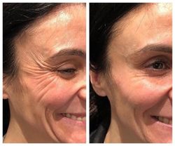 Beelift® Ορός Σύσφιξης Εφέ Botox - Image 11