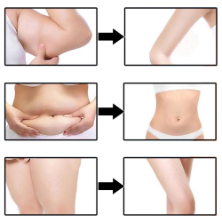 Body Cryo Lift® Κρέμα Κρυοθεραπείας & Σύσφιξης Σώματος - Image 9