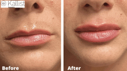 Full Lips Botox® Lip Plumper Treatment - Image 9